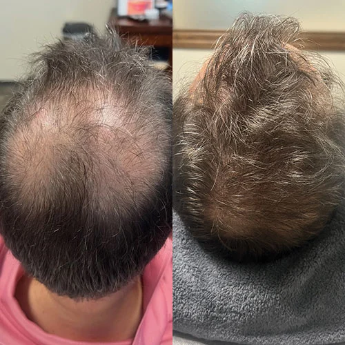 Before-after
