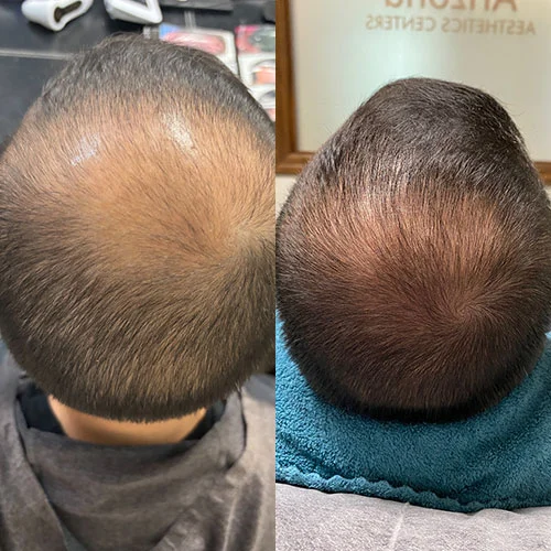 Before-after