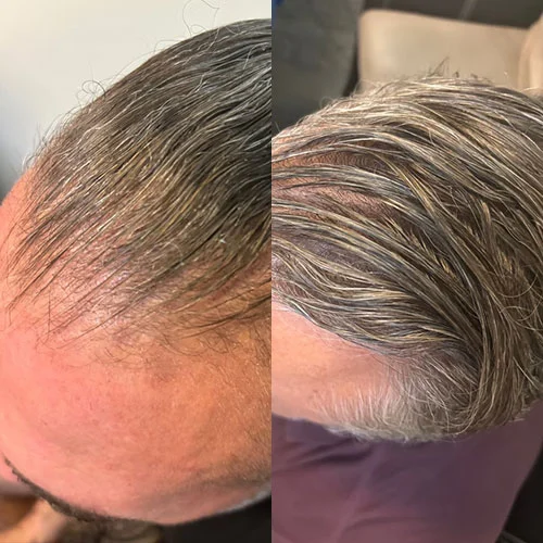 Before-after